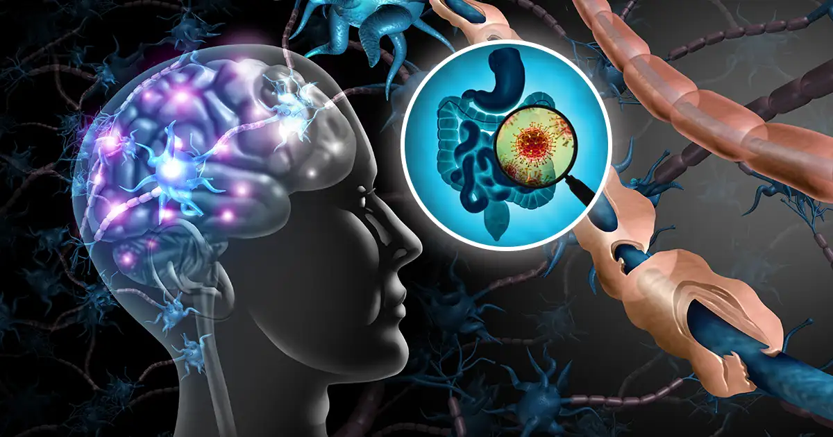 اختلال ميكروبيوم الأمعاء مرتبط بالتصلب المتعدد